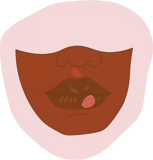 The Mystery Behind Cold Sores