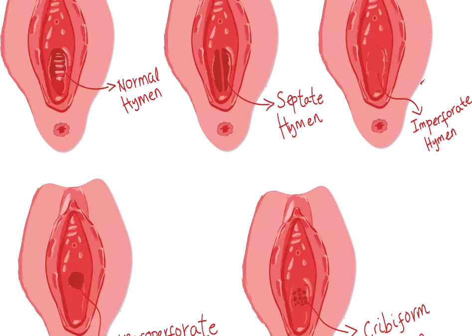 The Hymen, The ‘So-Called’ Sign of Virginity